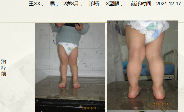 病例三十一