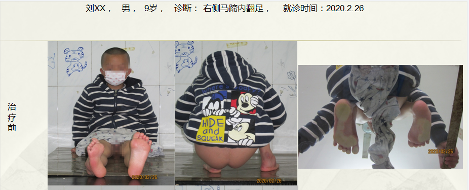 病例三十二