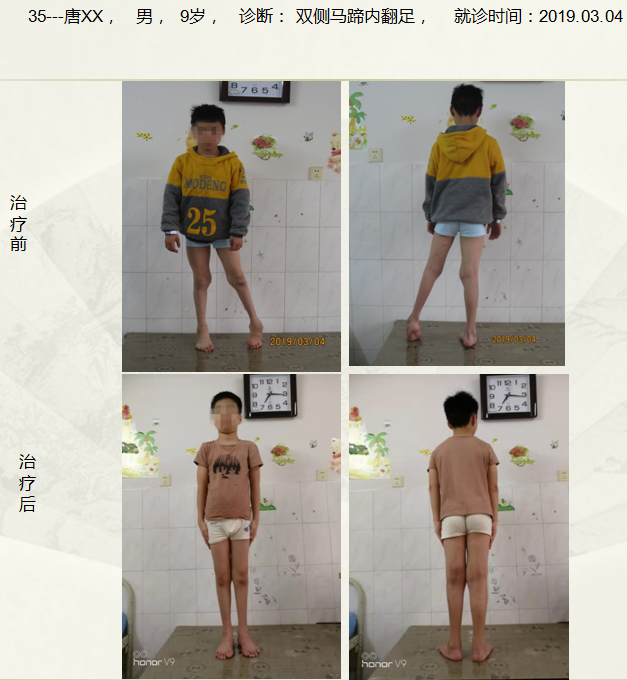 病例三十三