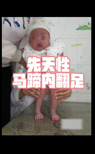 先天性马蹄内翻足
