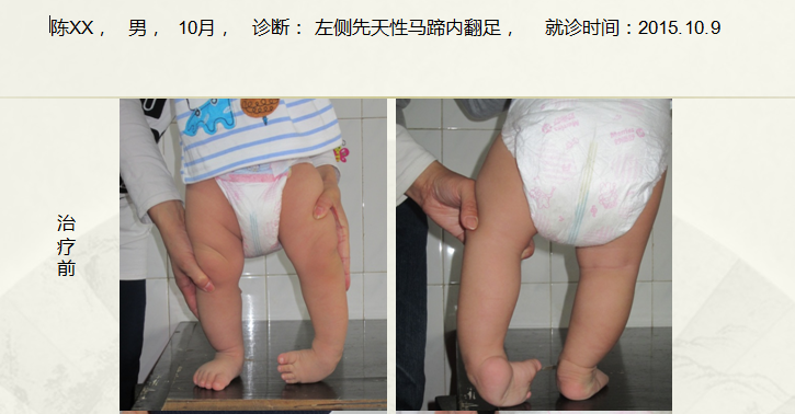 病例四十三