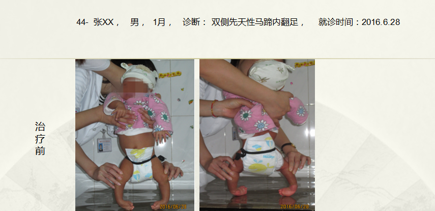 病例四十四