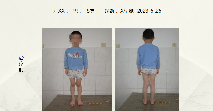 病例四十九例