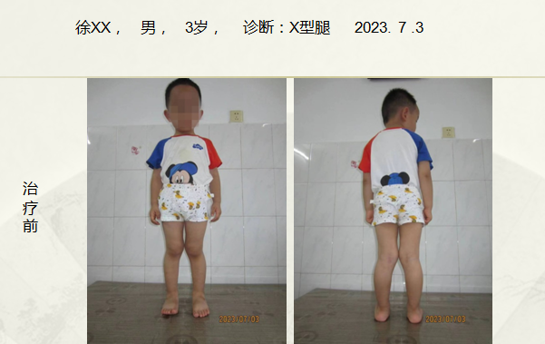 病例五十三