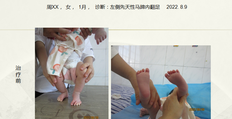 病例五十六