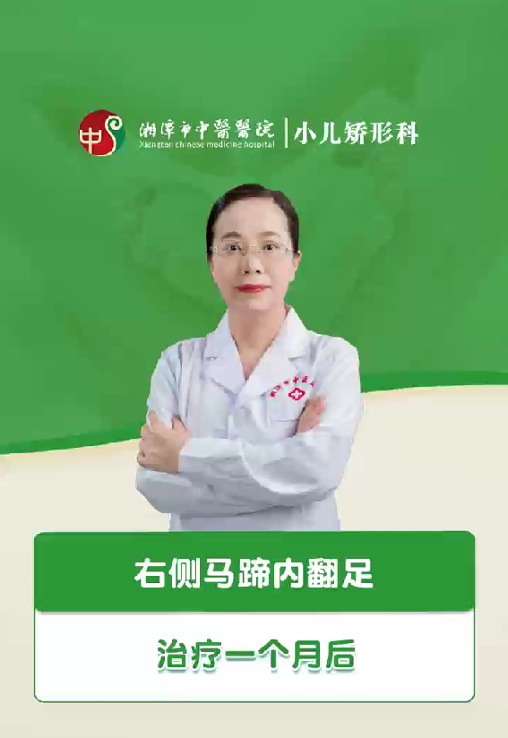 右侧马蹄内翻足治疗一个月后