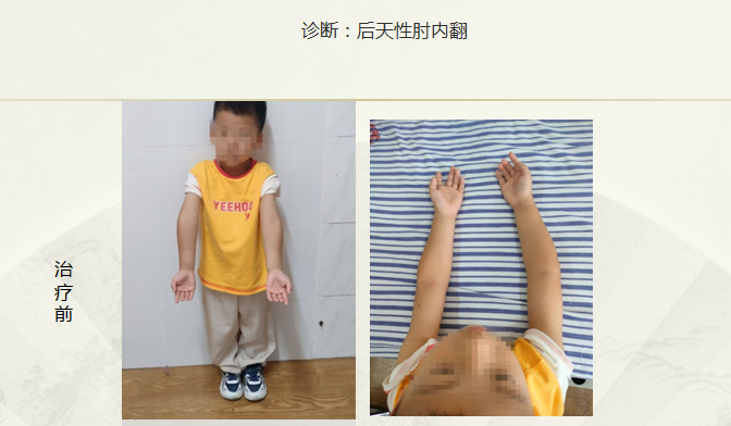 病例八十三